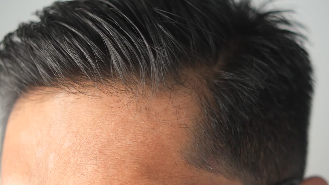 Close-up of a Man's Scalp with Possible Hair Loss