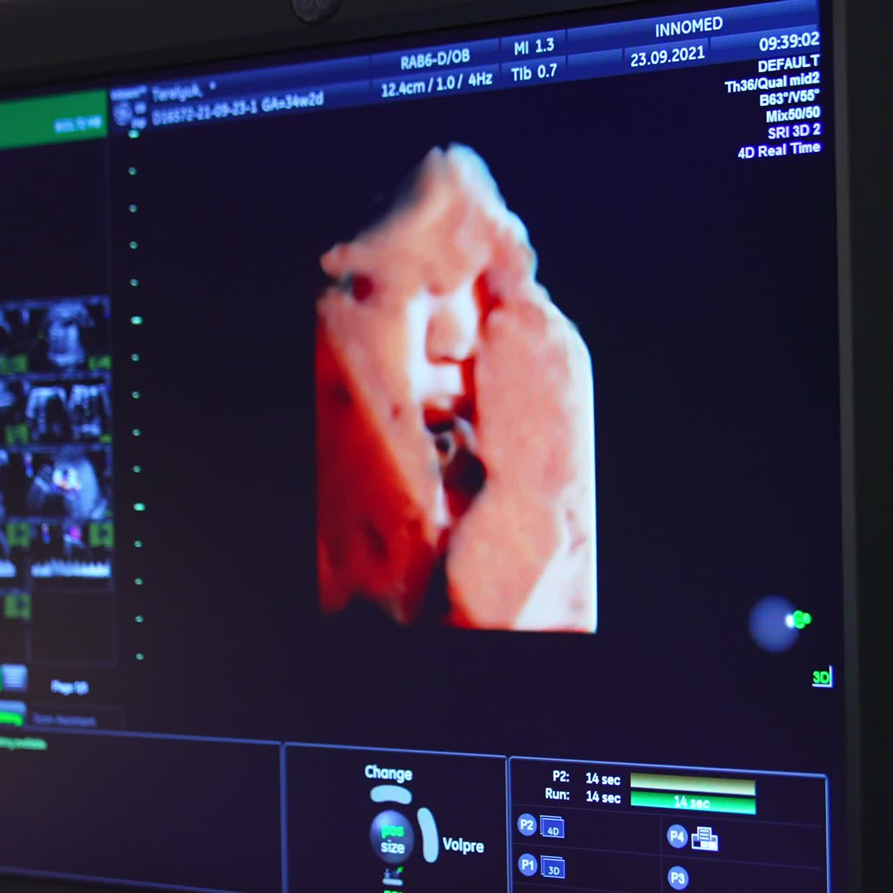 Baby moving in mom's belly shown at the screen. Life parameters on the blue monitor. Close up