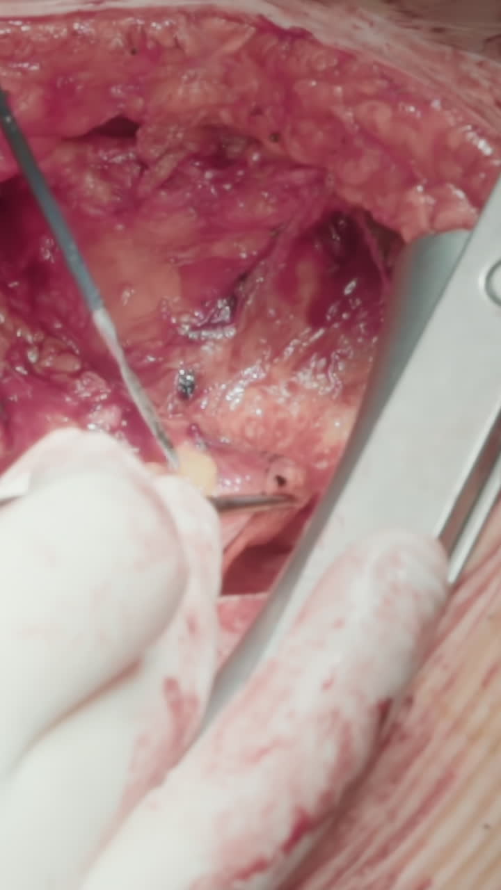 el médico alivia la obstrucción arterial. el cirujano aborda las arterias mediante la realización de una cirugía de derivación asegurando que el corazón reciba el suministro sanguíneo necesario en el hospital