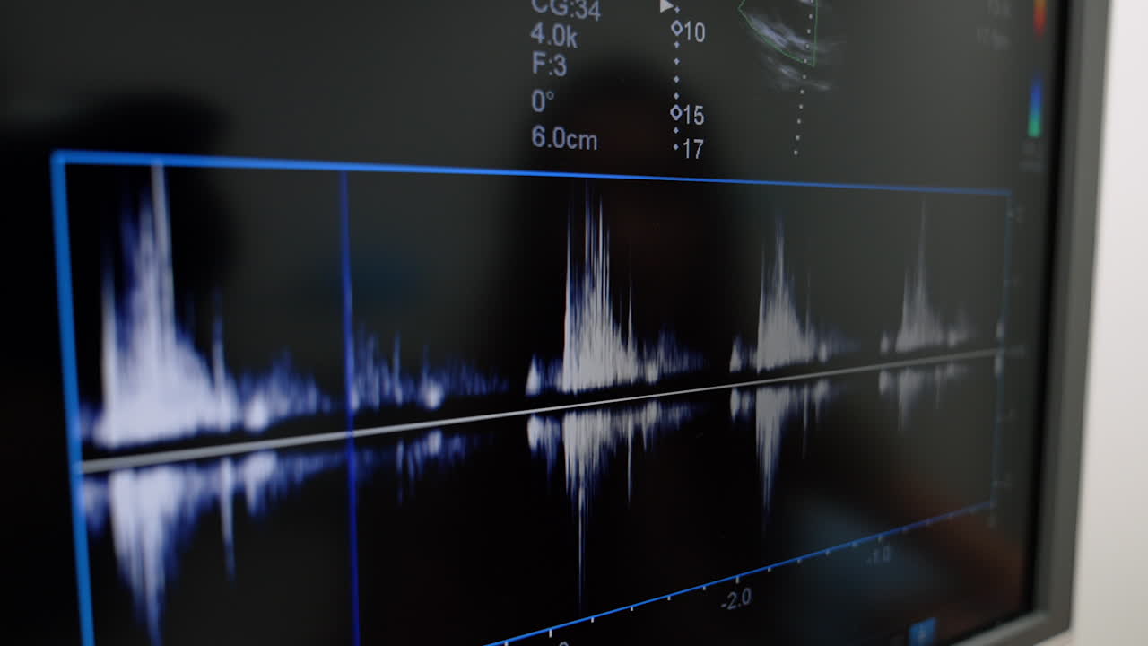 Doppler echocardiography waveform. Ultrasound monitor shows blood flow velocity graph during Doppler heart examination