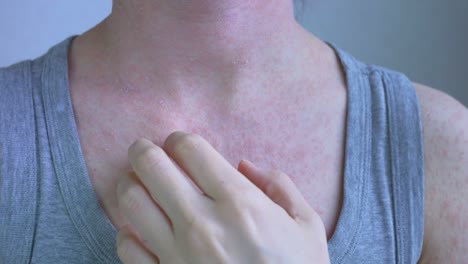 un video de primer plano muestra la parte superior del pecho y el hombro de la mujer. en estas áreas del cuerpo, una erupción alérgica aparece en un color rojo claro. la piel está rascada con uñas. enfermedades virales