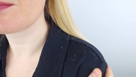 dandruff on a blond woman shoulder. side view of a female who has more dandruff flakes on his black shirt. scalp disease treatment concept. discomfort from a fungal infection. head fungus