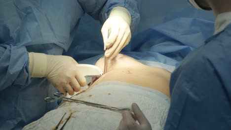 the surgeon prepares a sterile silicone breast implant for breast augmentation surgery