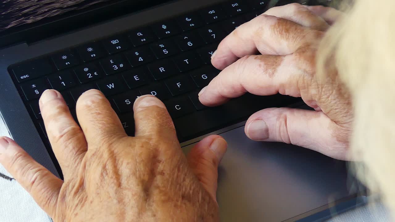 Vitiligo on the hands of a woman who works on the compute