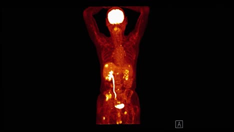 ct de mascota (tomografía por emisión de positrones) de todo el cuerpo humano 3d renderización de la imagen coronal vista tono de color rojo para detectar la recurrencia del tumor después de la cirugía.
