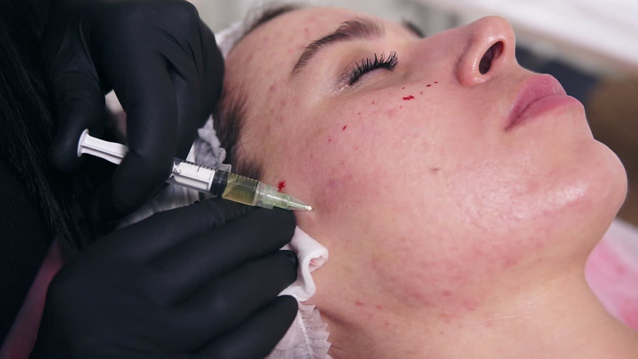 Professional cosmetologist makes multiple injections in woman's face skin during mesotherapy. Biorevitalization and face lifting