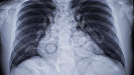 a detailed x-ray shows the structure of the human lungs and spine. viewer can observe the clarity of lung fields and adjacent anatomy, useful for medical assessments.