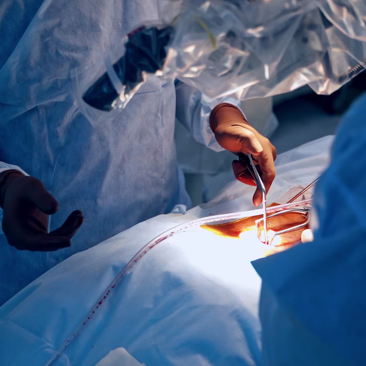 Surgery process. Group of surgeons doing an operation to a patient in the operating room. Medical instruments in doctor's hands. Close-up.