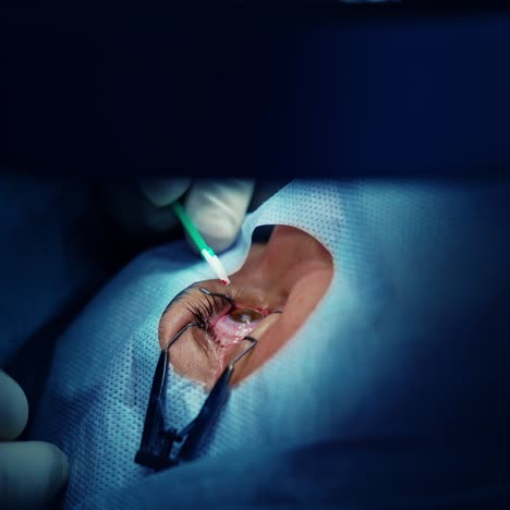 laser vision correction. doctor is performing operation on eye. patient's eye during ophthalmic surgery. lasik treatment. close-up