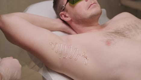 área de la axila del hombre durante el procedimiento de depilación láser en la clínica de cosmetología moderna. concepto de belleza del hombre, cosmetología, depilación
