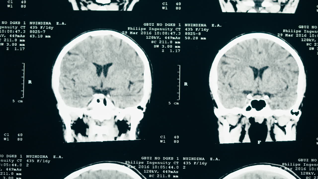 Tac mediche del cervello e del cranio umano