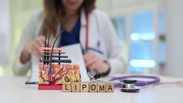La parola lipoma fatta di cubi di legno e un modello anatomico dello strato della pelle.