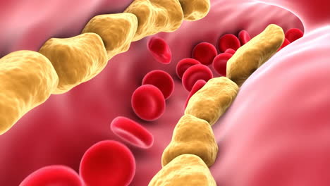 atherosclerosis: plaque buildup in artery