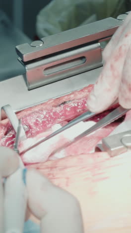 el médico muestra experiencia durante la cirugía. el cirujano utiliza pinzas para manejar la esponja durante una meticulosa cirugía de derivación de la arteria coronaria en la sala de operaciones de la clínica