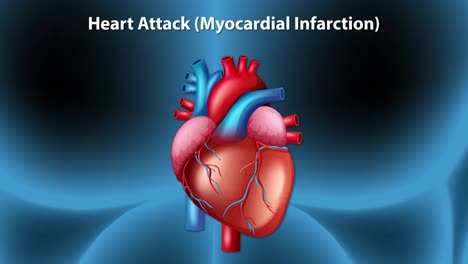 animation illustrates myocardial infarction progression with detailed heart anatomy and artery blockage visualization