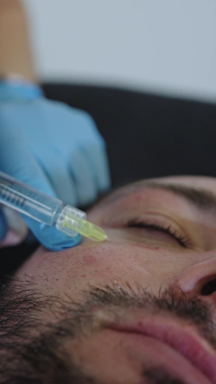 Questo primo piano cattura un medico specializzato in medicina estetica, mentre esegue una precisa iniezione intradermica di polinucleotidi su un paziente di sesso maschile.