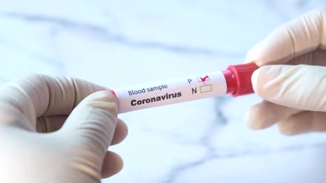 coronavirus blood sample testing