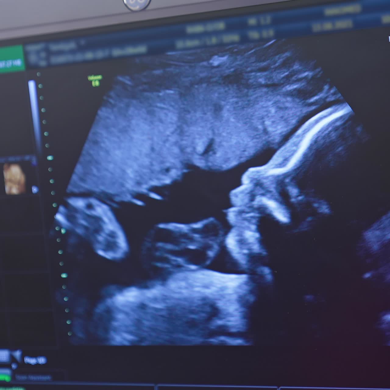 Immagini colorate di un bambino sullo schermo durante l'ecografia. Il monitor mostra l'embrione del futuro bambino durante la procedura ecografica di una donna incinta