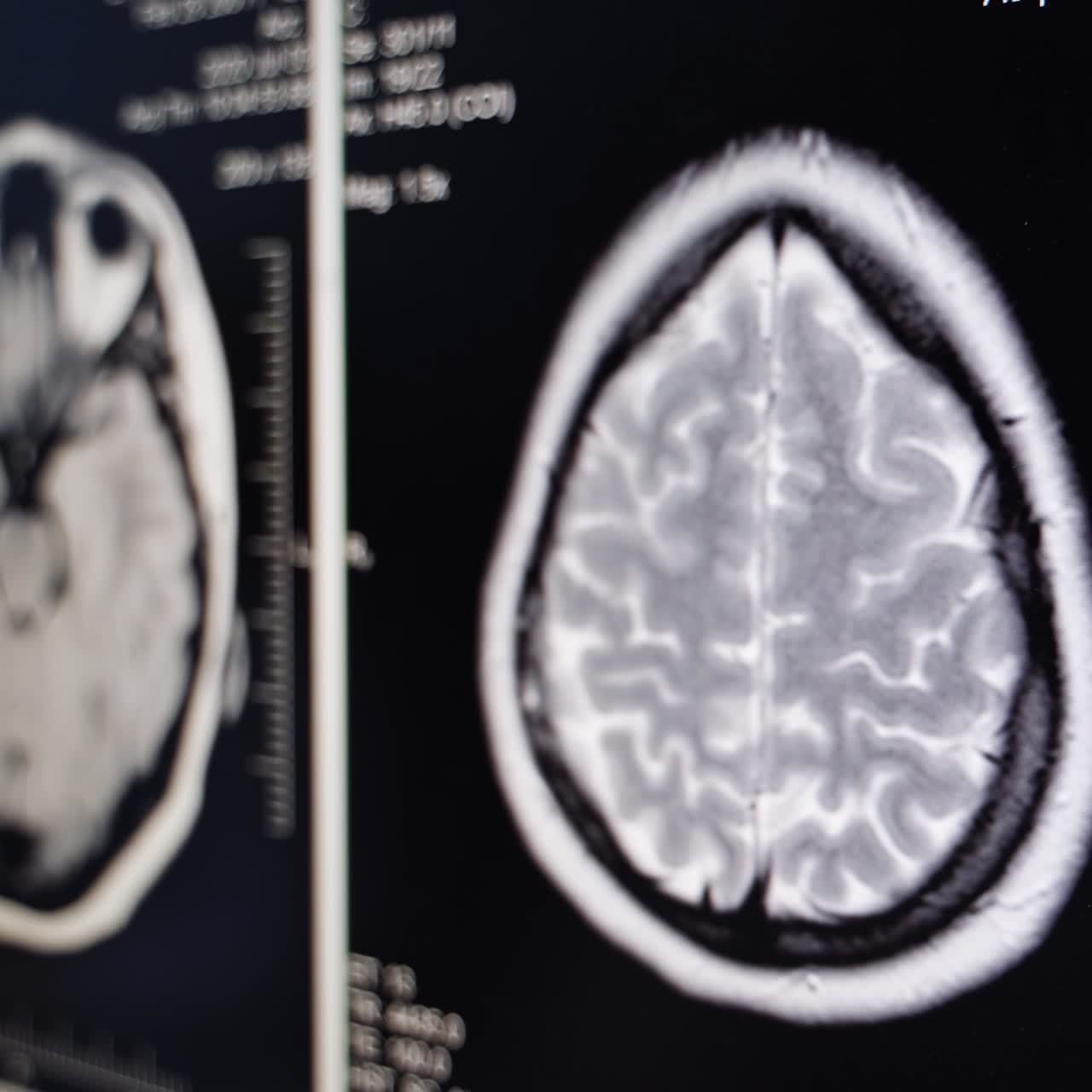 Magnetic resonance scanning of human brain. Computer screen with moving image of brain. Close up