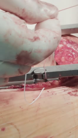 las manos del cirujano comprueban los esparcidores de costillas metálicas para mantener el pecho del paciente abierto. cirugía de trasplante de la arteria coronaria en la clínica