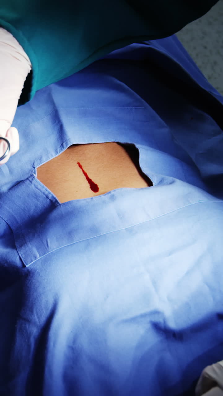 cirujanos que realizan una operación en la sala de operaciones