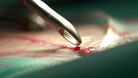 surgeons meticulously perform a procedure, showcasing precision and skill as they navigate through layers of tissue. the environment reflects a focused and sterile atmosphere during the operation.