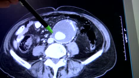 Medizinisches-Aneurysma-Im-Bauch-Beim-Katzenscan