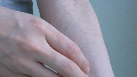 close-up video shot. on the left hand, skin manifestations of a pinkish color are an allergic reaction. with the tips of the fingers of the right hand, they are led along them