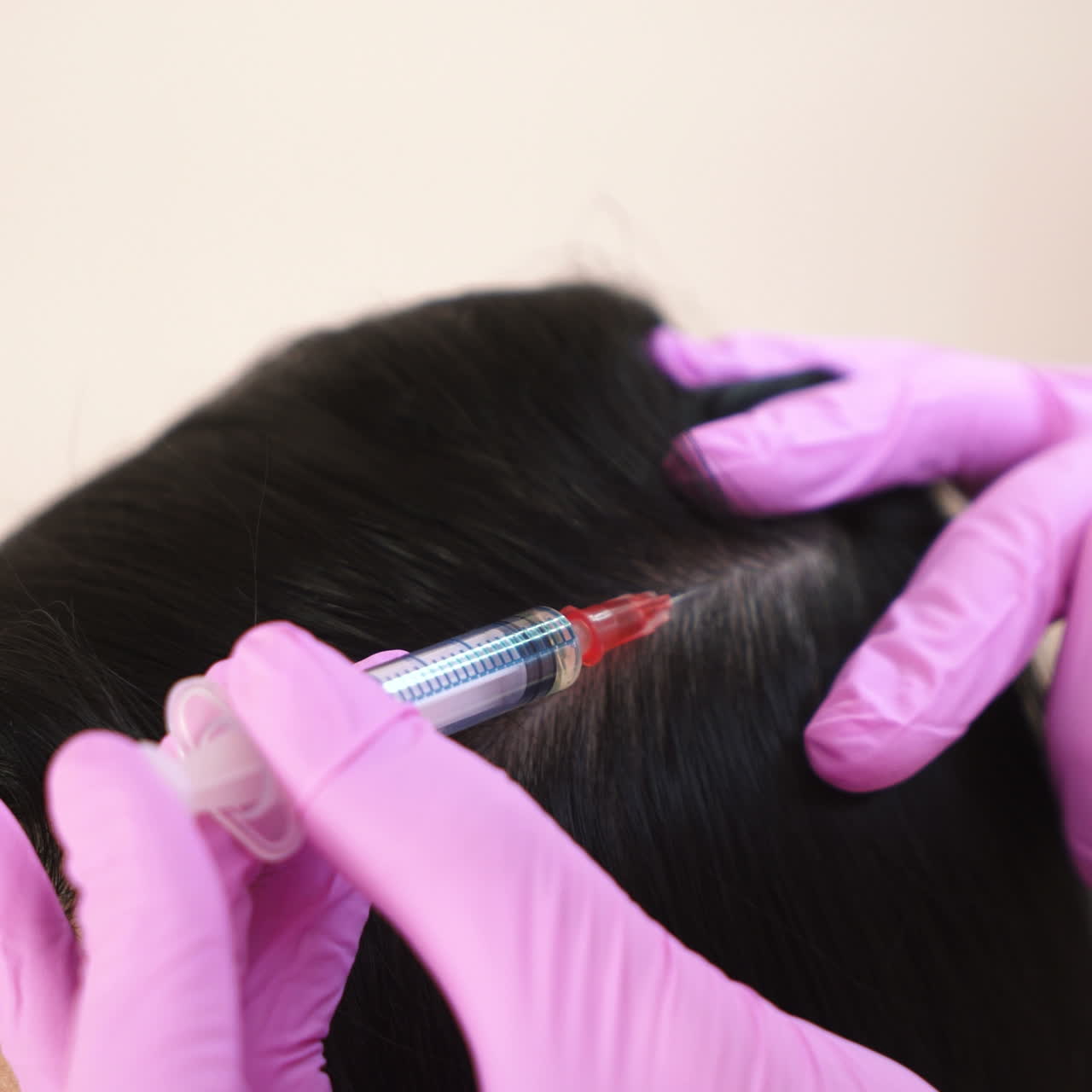 Beautiful young woman receives an injection in the head in the center of aesthetic medicine. Prevention and treatment of hair growth