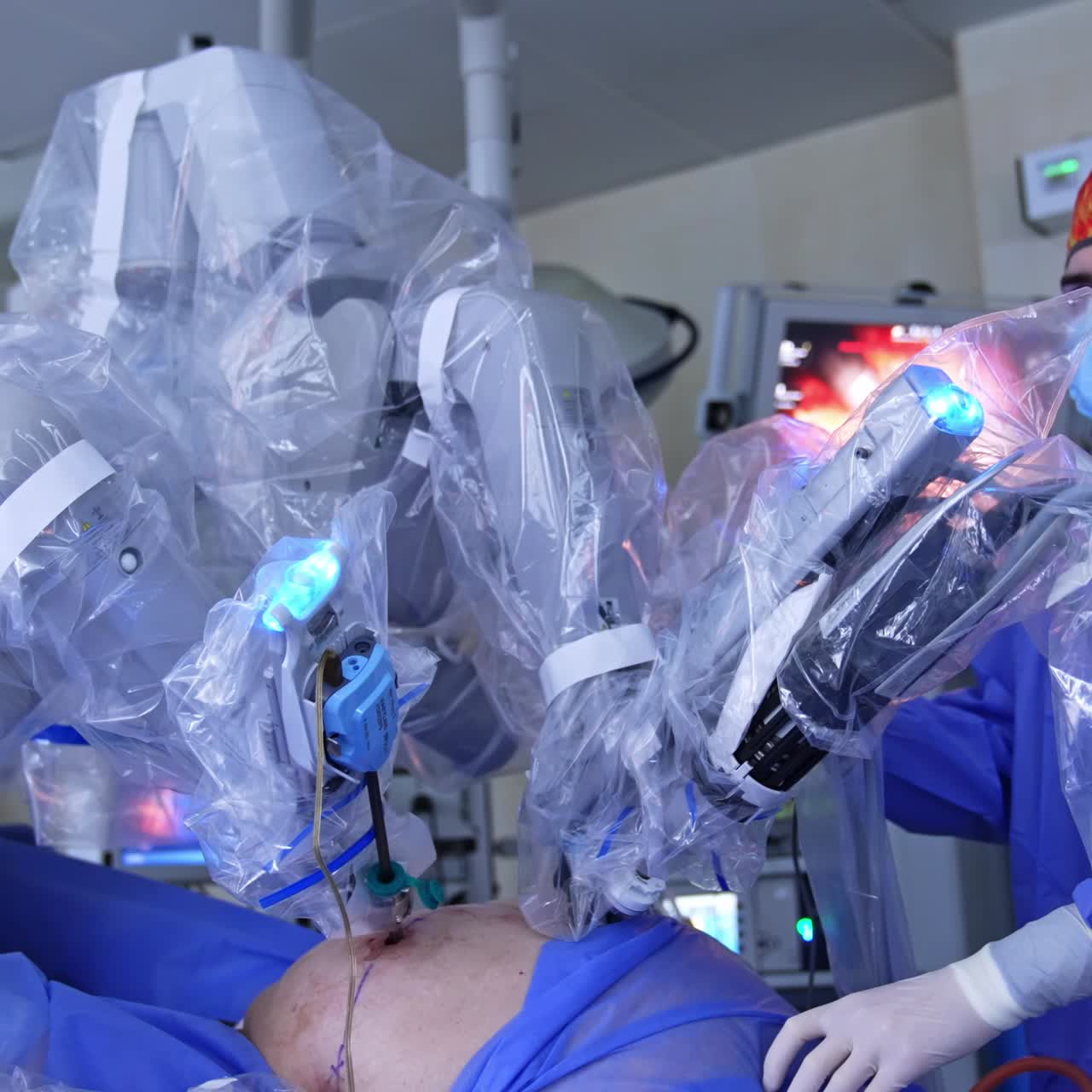 Massive robotic arms coated in plastic move in the patient's body. Laparoscopy conducted by Da Vinci surgeon. Male surgeon in colorful cap stands near equipment