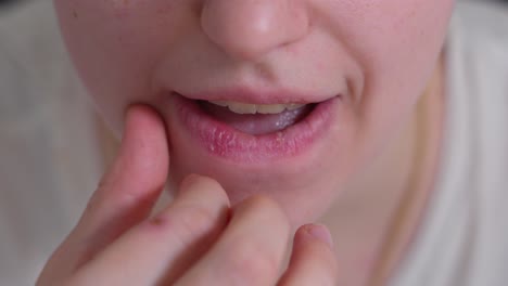 a lady is removing dry skin from her chapped lips - close up