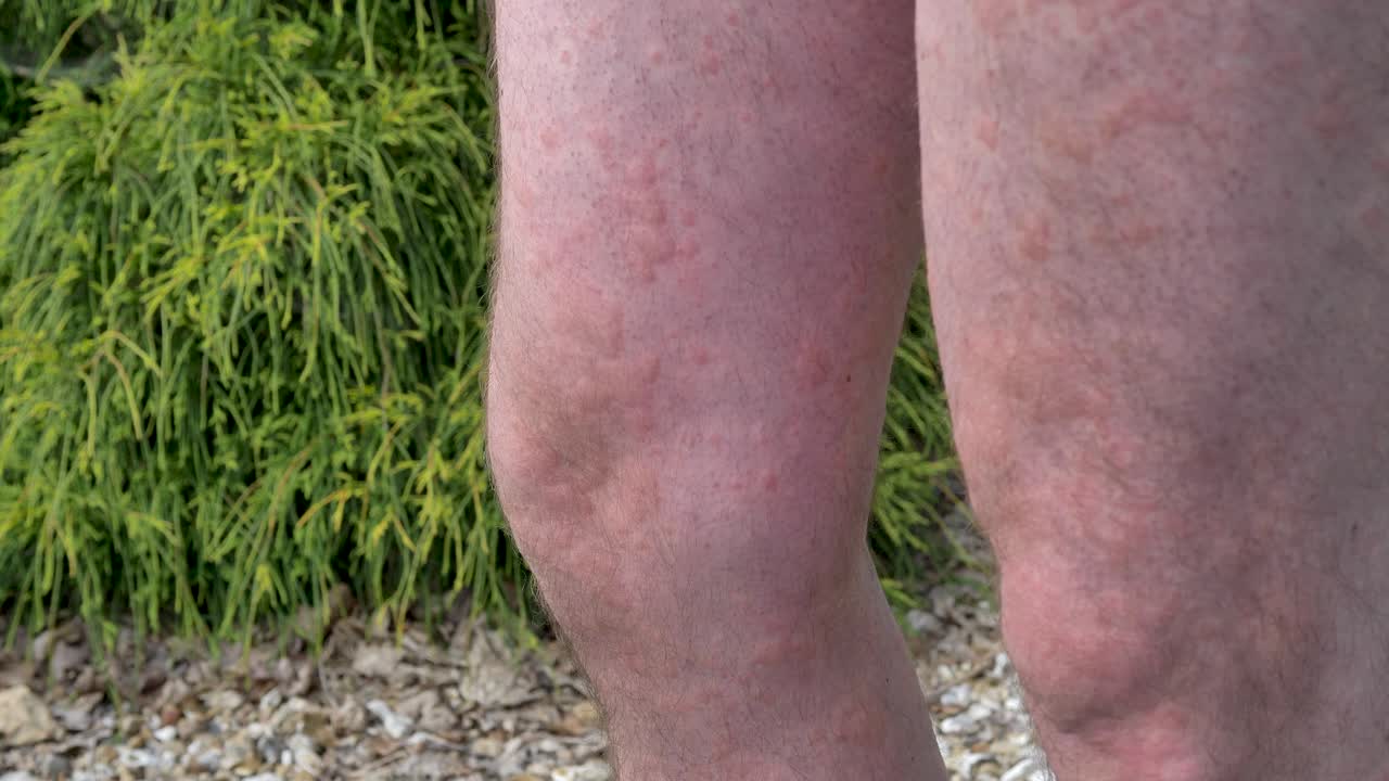 백인 남성의 무과 다리는 벌레로 여 있습니다.