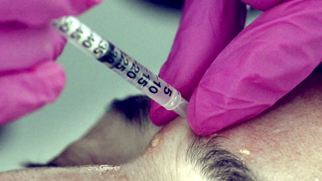 primer plano del rostro de una mujer que recibe inyecciones de botox