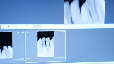 x-ray shots of uneven teeth raw. films of incorrect denture on the computer screen. close up.