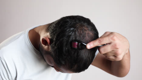 man applying microneedling hair loss treatment for bald scalp to treat male pattern baldness