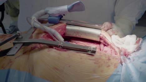 medical staff of the operating unit do heart surgery preparing to install a shunt