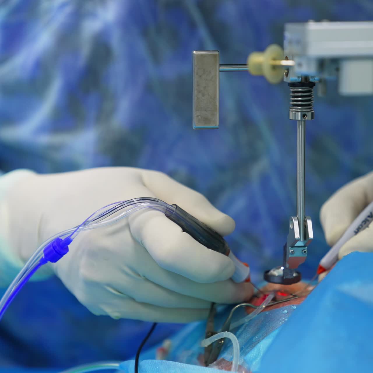 Gloved hands of surgeon moving electric tools in the patient's eye. Equipment placed over the operated eye. Blurred backdrop