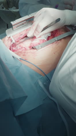 el cirujano retira la sangre de la herida con un primer plano del corazón latente. el médico cardiólogo con una herramienta láser durante la cirugía de derivación de la arteria coronaria en un hospital especializado