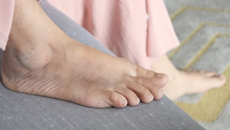 close up of women feet with swelling