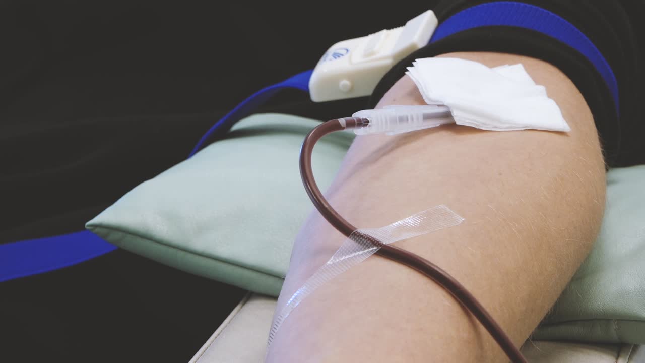Primo piano di un donatore di sangue sdraiato su una sedia clinica con ago e tubi attaccati, che stringe una palla antistress rossa durante il processo di donazione del sangue in un ambiente medico
