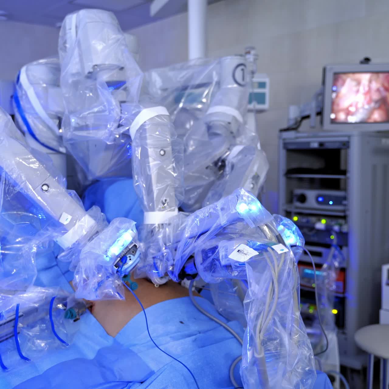 Innovative technology in surgery. Robotic arms of surgical robot perform surgery on a patient. Hi-tech medical equipment in the operating room. Close-up.