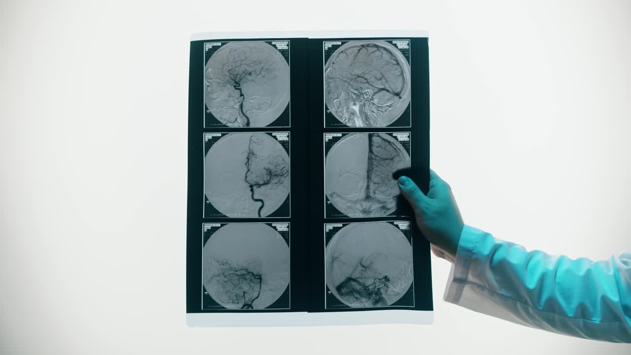 Helsepersonell som undersøker hjerneangiografi-skanning