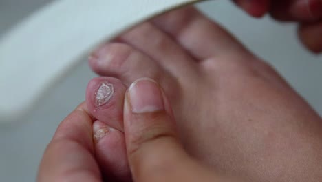 Toe-Nail-Trimming,-Nail-Trauma-HomeTreatment,-close-up-4K-footage