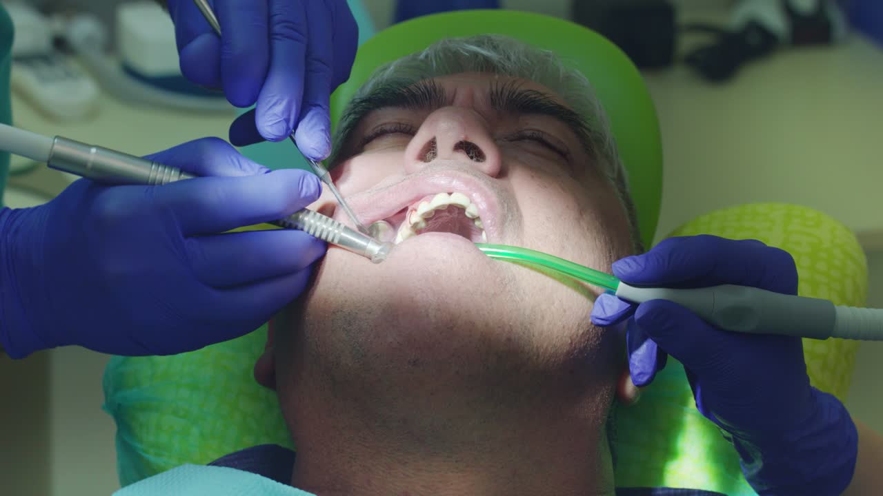 el dentista perfora el diente del paciente. las manos del dentista trabajan en la cavidad oral abierta