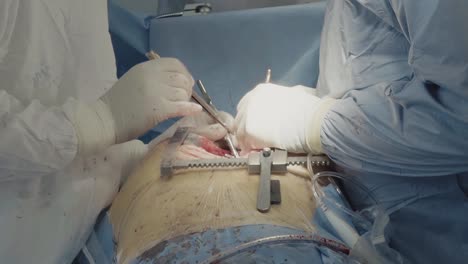 two surgeons are on aorto-coronary bypass surgery