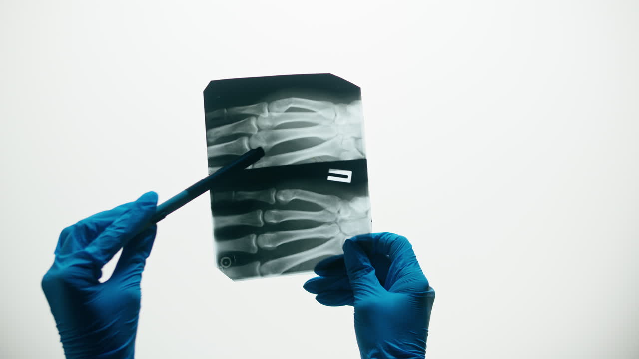 Doctor in Blue Gloves Examining Hand X-ray with a Pen