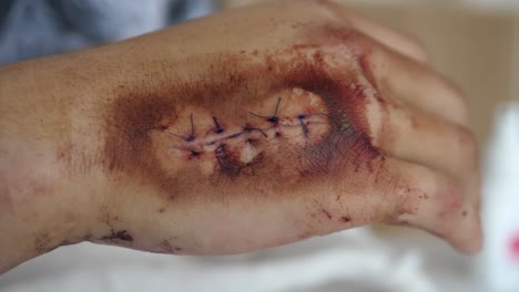 close up shot of bloody stitches on  arm