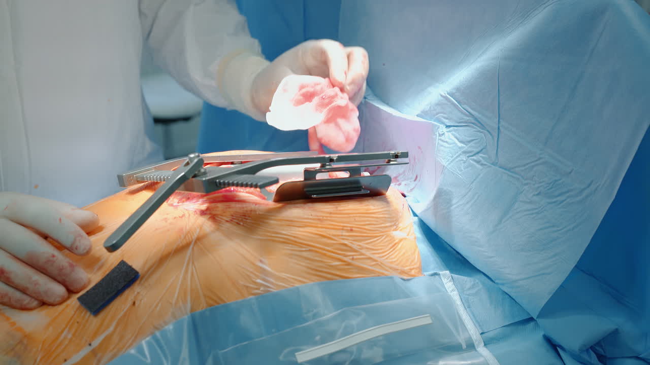 el cirujano expande el pecho del paciente con un primer plano del dilatador. el médico prepara la herida para una cirugía de derivación de la arteria coronaria en el hospital. procedimientos médicos