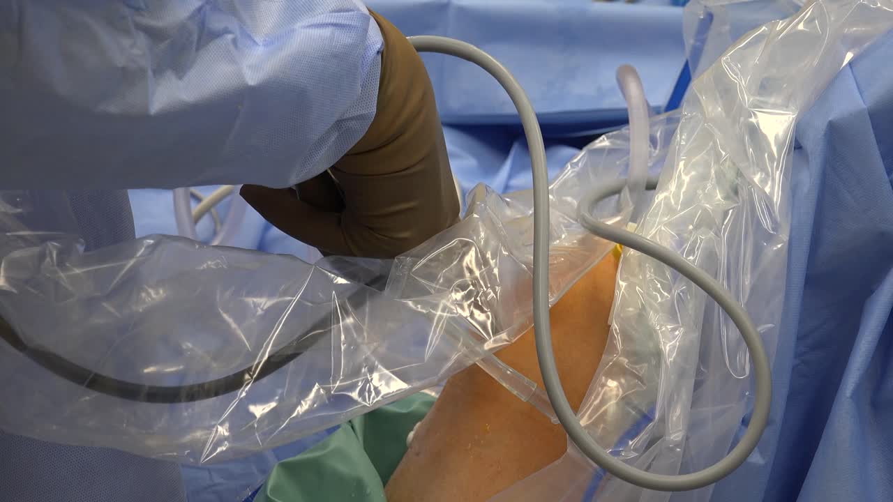 la reconstrucción del ligamento cruzado anterior es un reemplazo quirúrgico con injerto de tejido del ligamento cruzado anterior, ubicado en la rodilla, para restaurar su función después de una lesión.