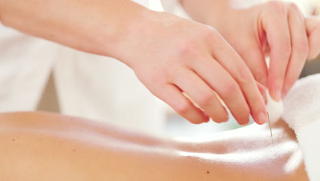 Closeup-of-client-having-acupuncture-needles